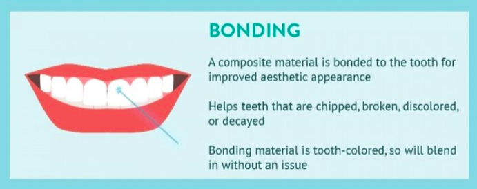 a diagram of dental bonding